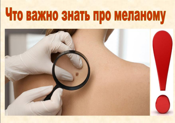 Что важно знать про меланому